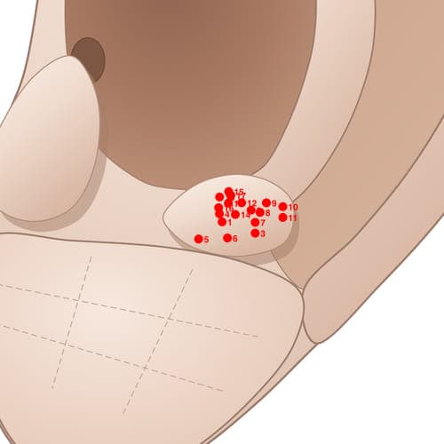 Location of acupuncture point AT01 (Stop Asthma)