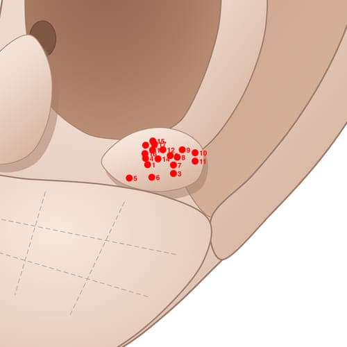 Location of acupuncture point AT03 Ding (Vertex)
