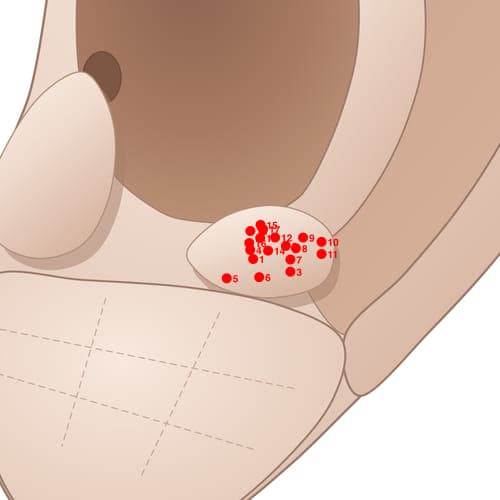 Location of acupuncture point AT04 Saixian (Parotid)
