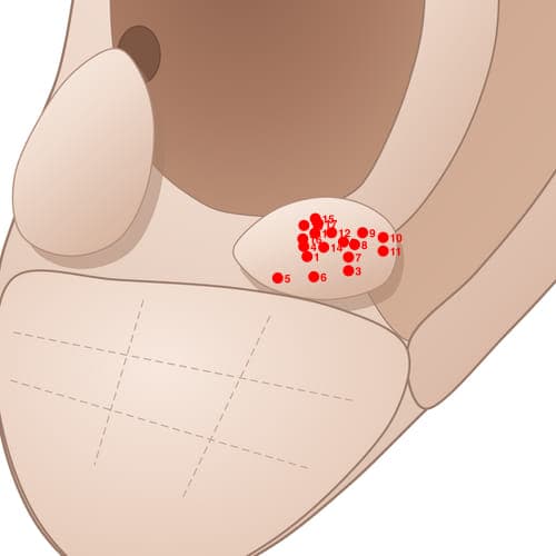 Location of acupuncture point AT05 (Forehead)
