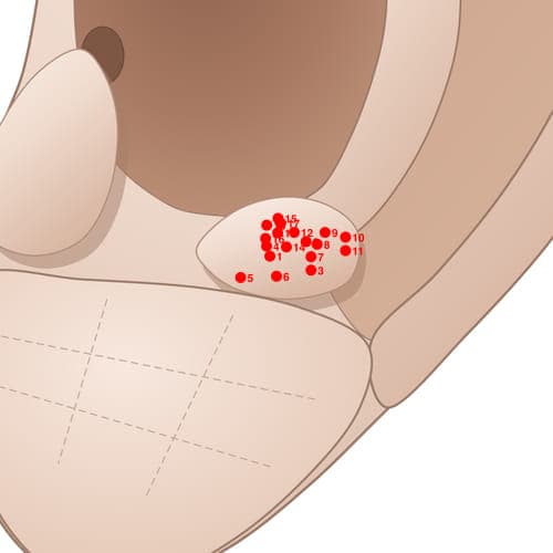 Location of acupuncture point AT06 Nie (Temple)