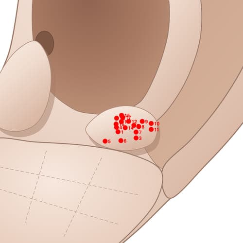 Location of acupuncture point AT13 Xiaohuapizhixia (Digestive Subcortex)