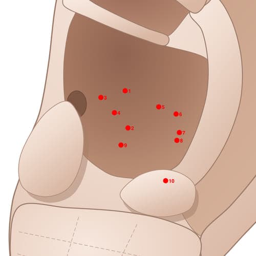 CVC02 acupoint