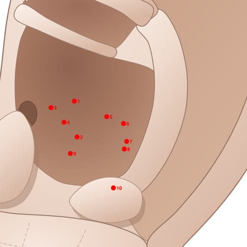 Location of acupuncture point CVC06 (Spleen)