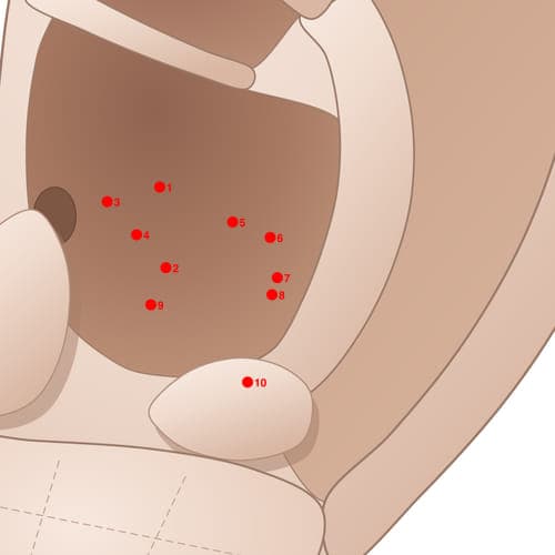 Location of acupuncture point CVC07 (Splenomegaly Area)