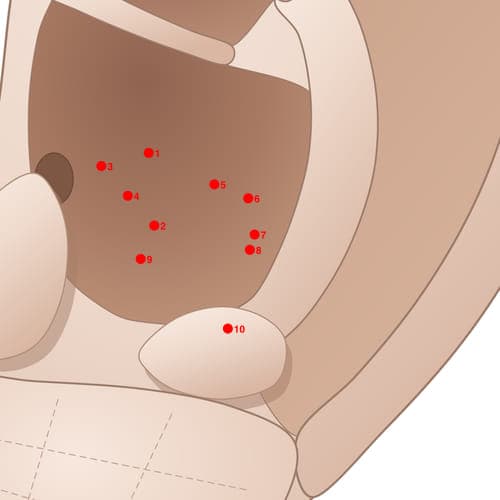 Location of acupuncture point CVC08 (Blood Point)