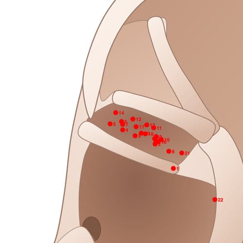 Location of acupuncture point CYC06 Xiajiao (Lower Jiao)