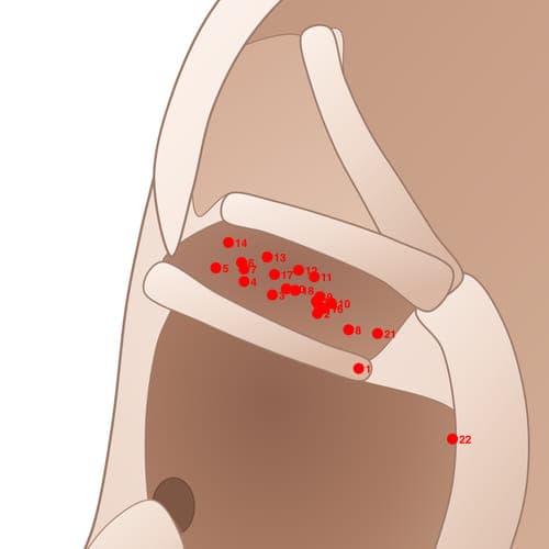 CYC17 acupoint
