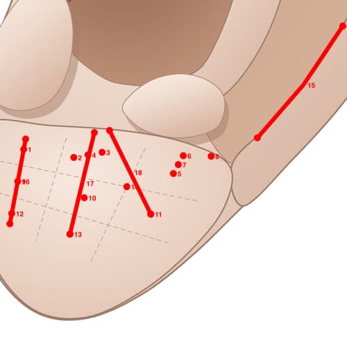 Location of acupuncture point EL05 (Upper Jaw)