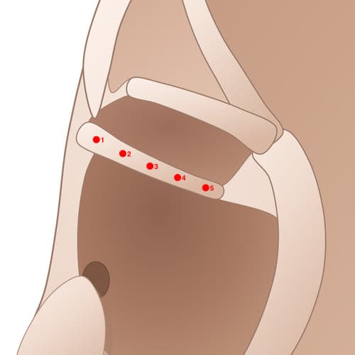 HCS04 acupoint