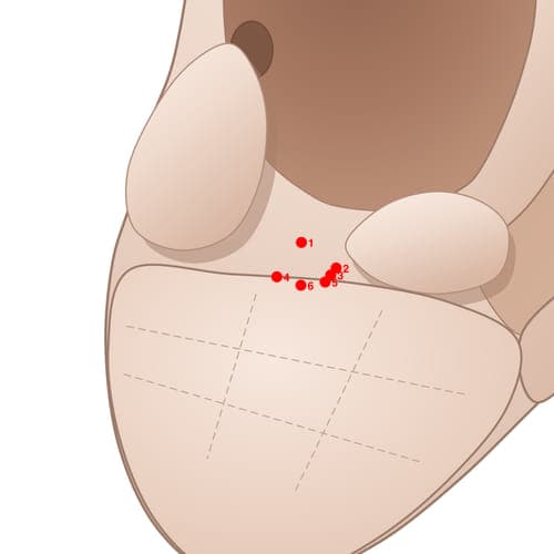 Location of acupuncture point IN04 (Vision 1)