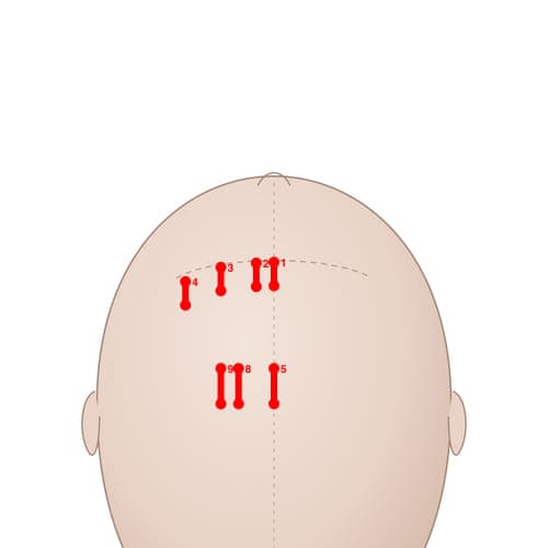 Location of acupuncture point MS01 (Middle Line of Forehead)