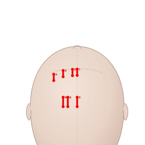 MS02 acupoint