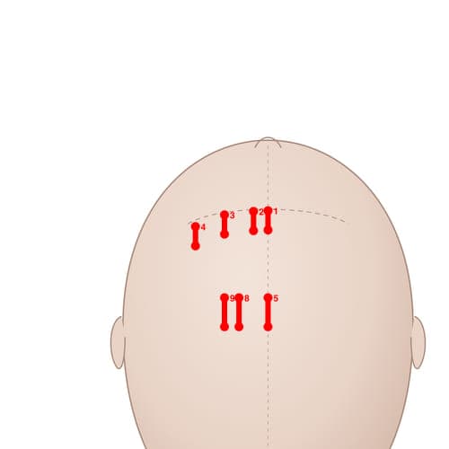 Location of acupuncture point MS03 (Lateral Line 2 of Forehead)