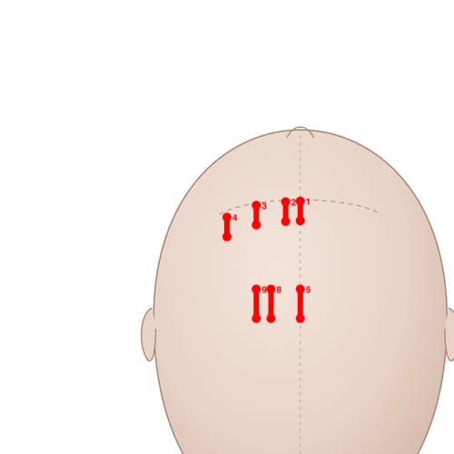 Location of acupuncture point MS04 (Lateral Line 3 of Forehead)