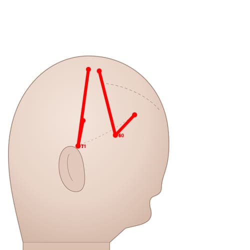 Location of acupuncture point MS10 (Anterior Temporal Line)