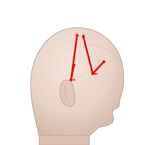 Location of acupuncture point MS11 Niehouxian (Posterior Temporal Line)