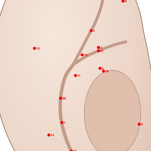 Location of acupuncture point POS11 Zuogushenjingsanjiaoqu (Triangle Area of Sciatic)