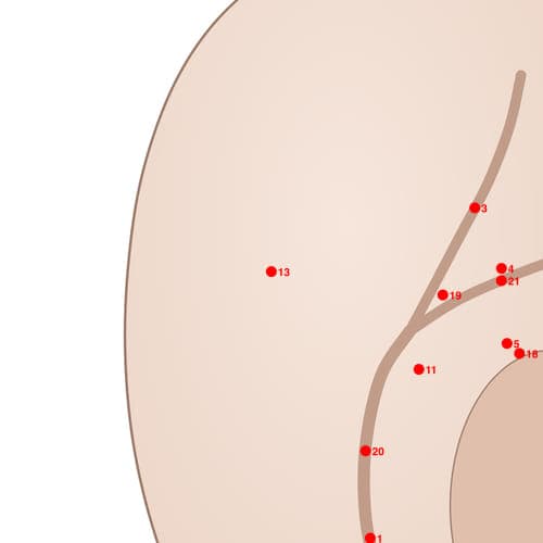 Location of acupuncture point POS13 (Tennis Elbow Point)