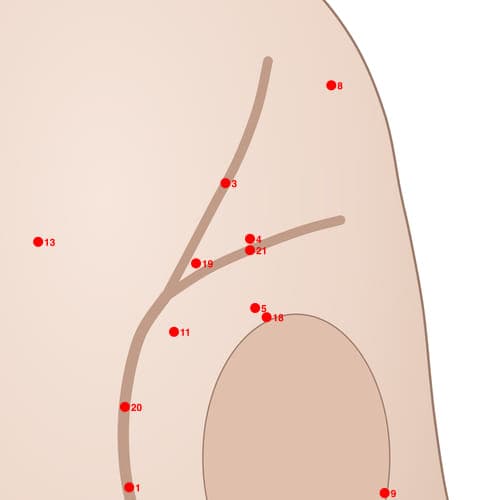 Location of acupuncture point POS21 (Sciatic Nerve Posterior)