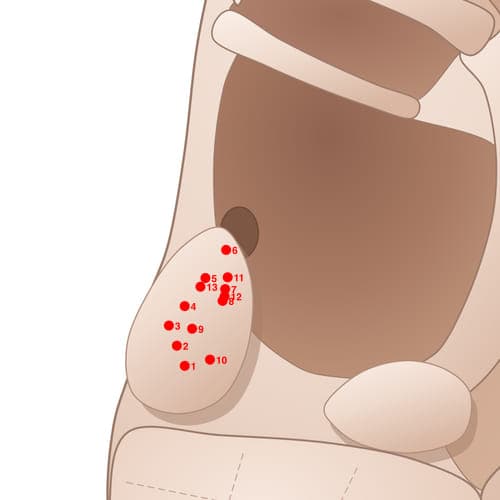 Location of acupuncture point TR06 (External Ear)