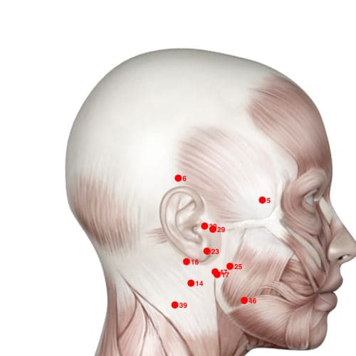 Location of acupuncture point XH06 (Tip Of The Ear)