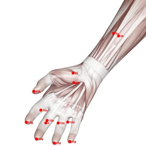 XU22 acupoint